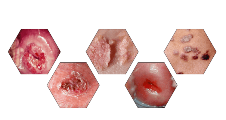 Kodėl papilomos pavojingos