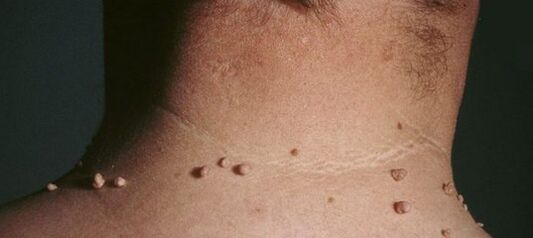 kaip atsikratyti papilomų