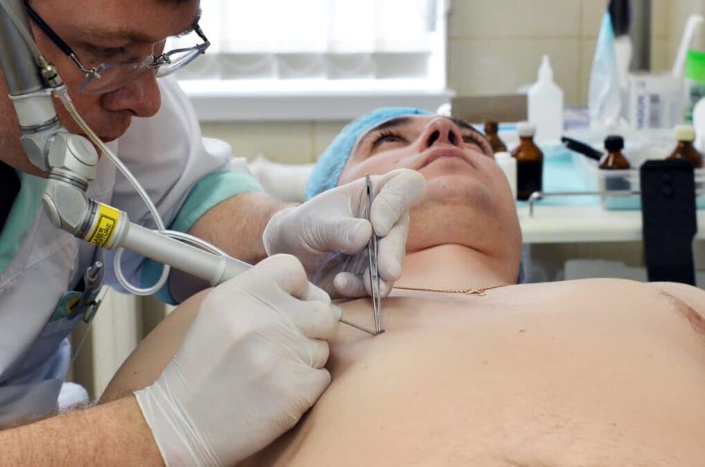 kaip atsikratyti karpų ant kūno