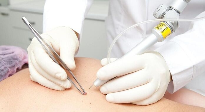 papilomos pašalinimas lazeriu dėl papilomos viruso
