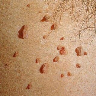 Papilomos dažnai auga kolonijomis ir gali atsirasti ant viso kūno odos